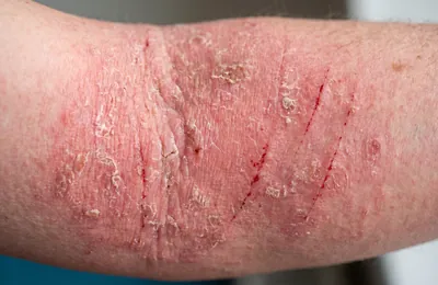 アトピー性皮膚炎