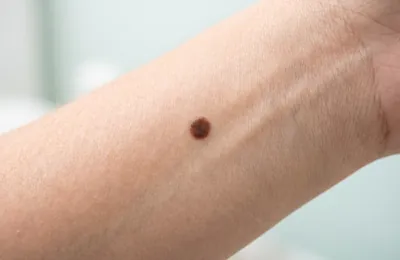 ほくろ