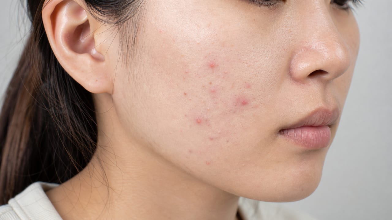 成人女性の頬にみられる面皰と小さな炎症性ニキビ
