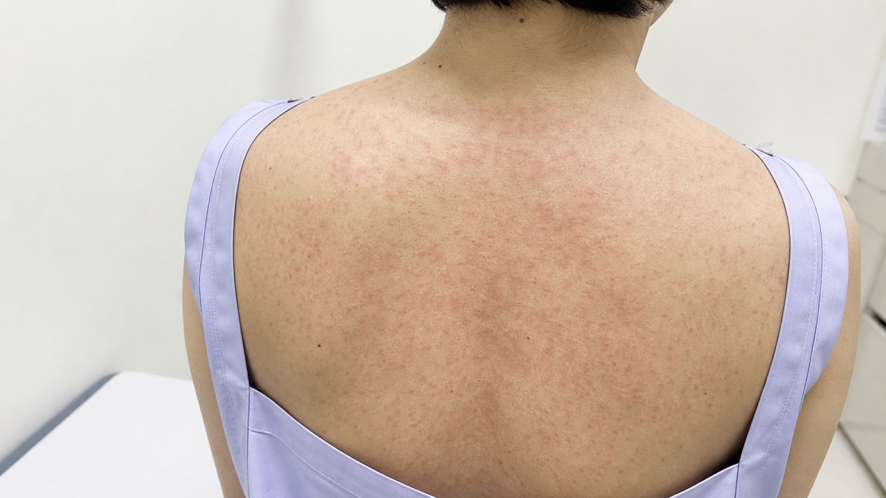成人の上背部に広がる軽度の斑状丘疹型薬疹の症状