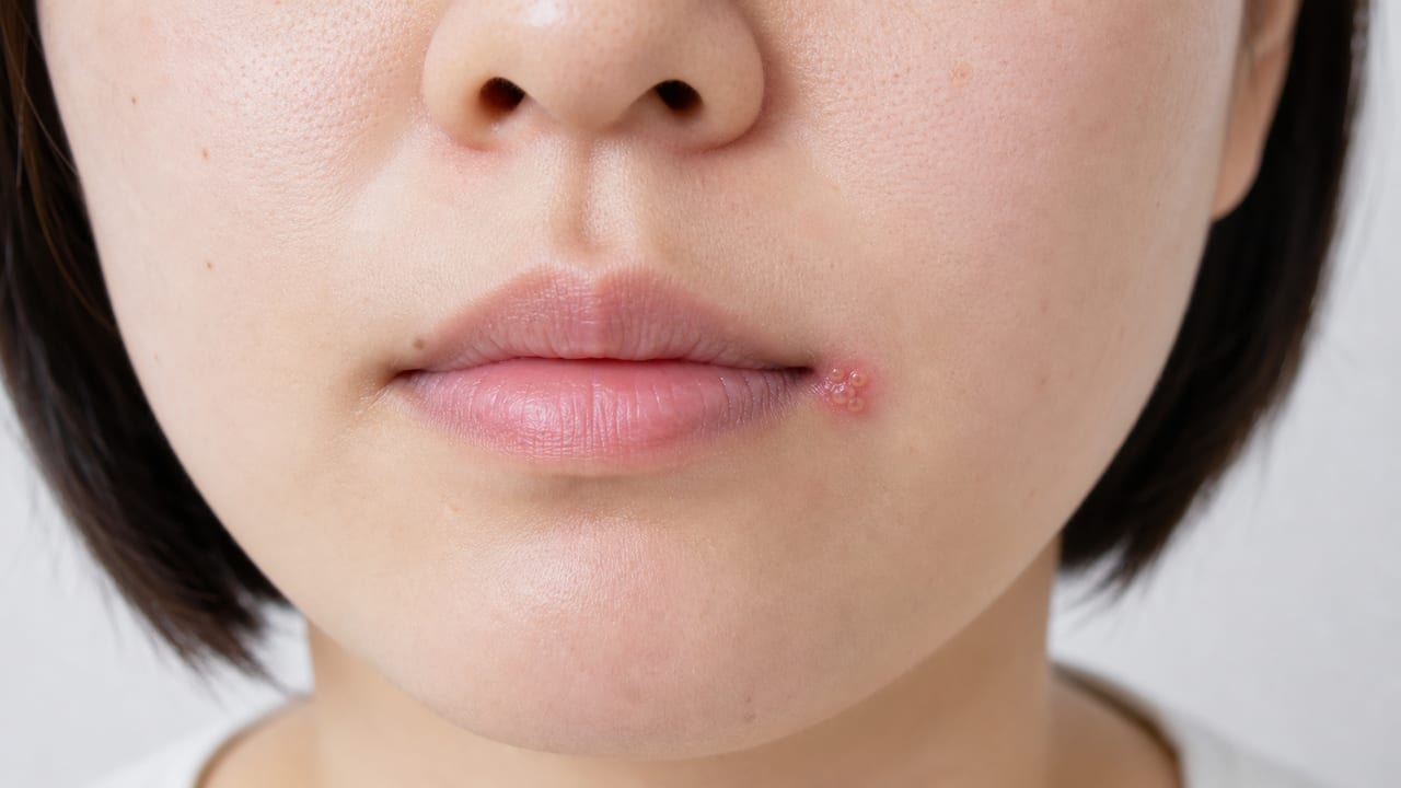 成人の口角付近に小さな水疱が集まってみられる口唇ヘルペスの症状例