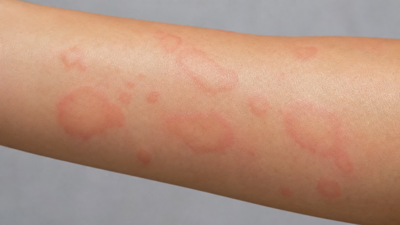 成人の腕にみられる赤く盛り上がったじんましんの膨疹