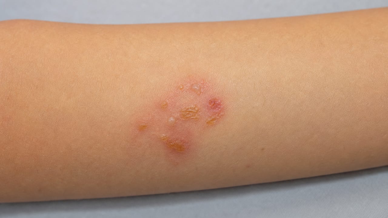 子どもの前腕にみられる小さな水疱と蜂蜜色のかさぶた