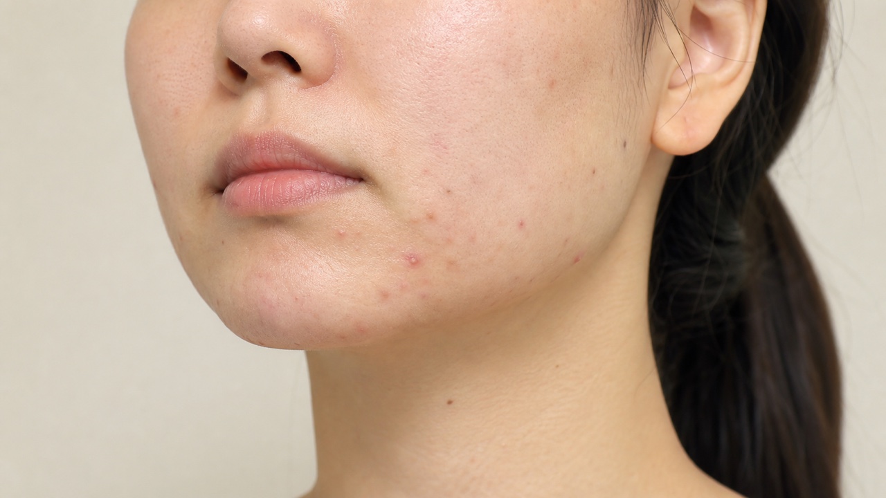 頬からフェイスラインにみられる面皰と小さな炎症性ニキビ