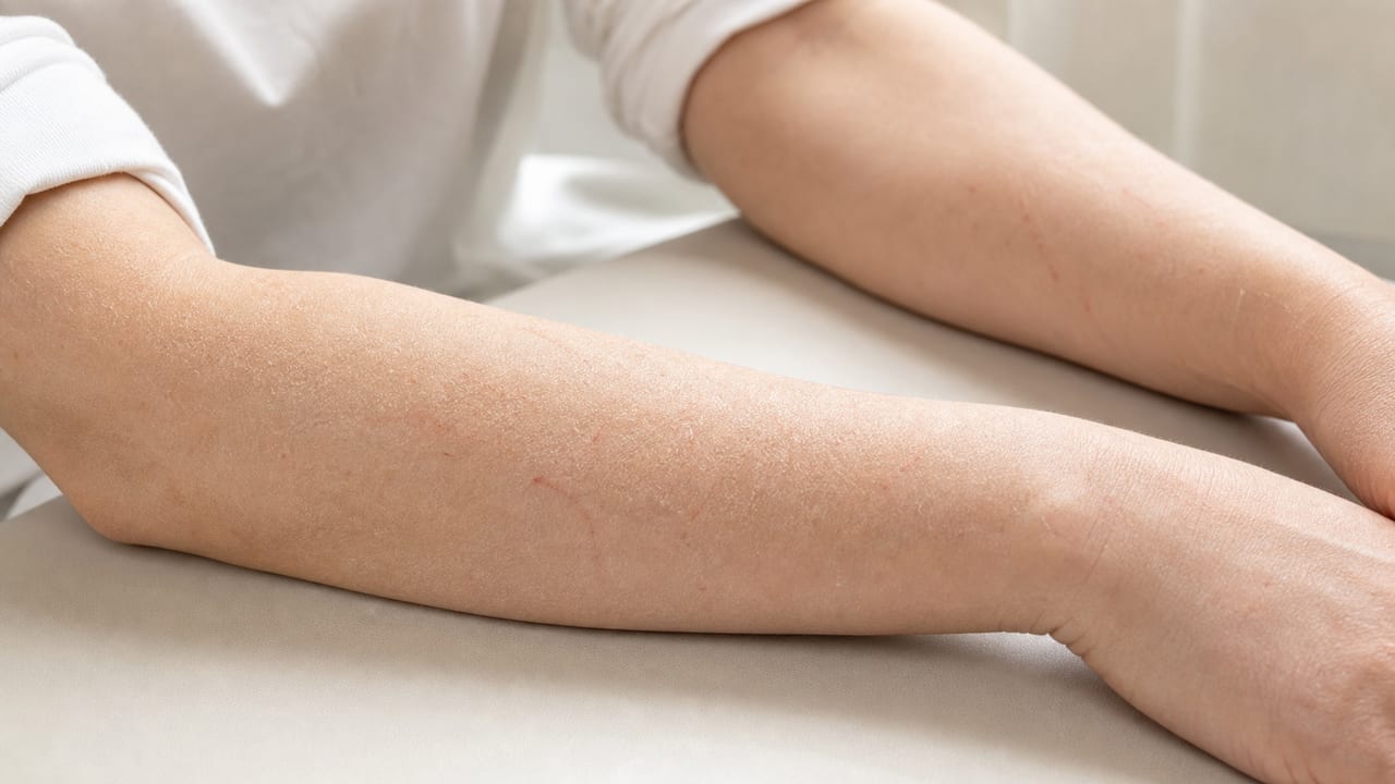 皮膚そう痒症の乾燥と掻き傷 成人の前腕にみられる乾燥、細かな鱗屑、軽い掻き傷