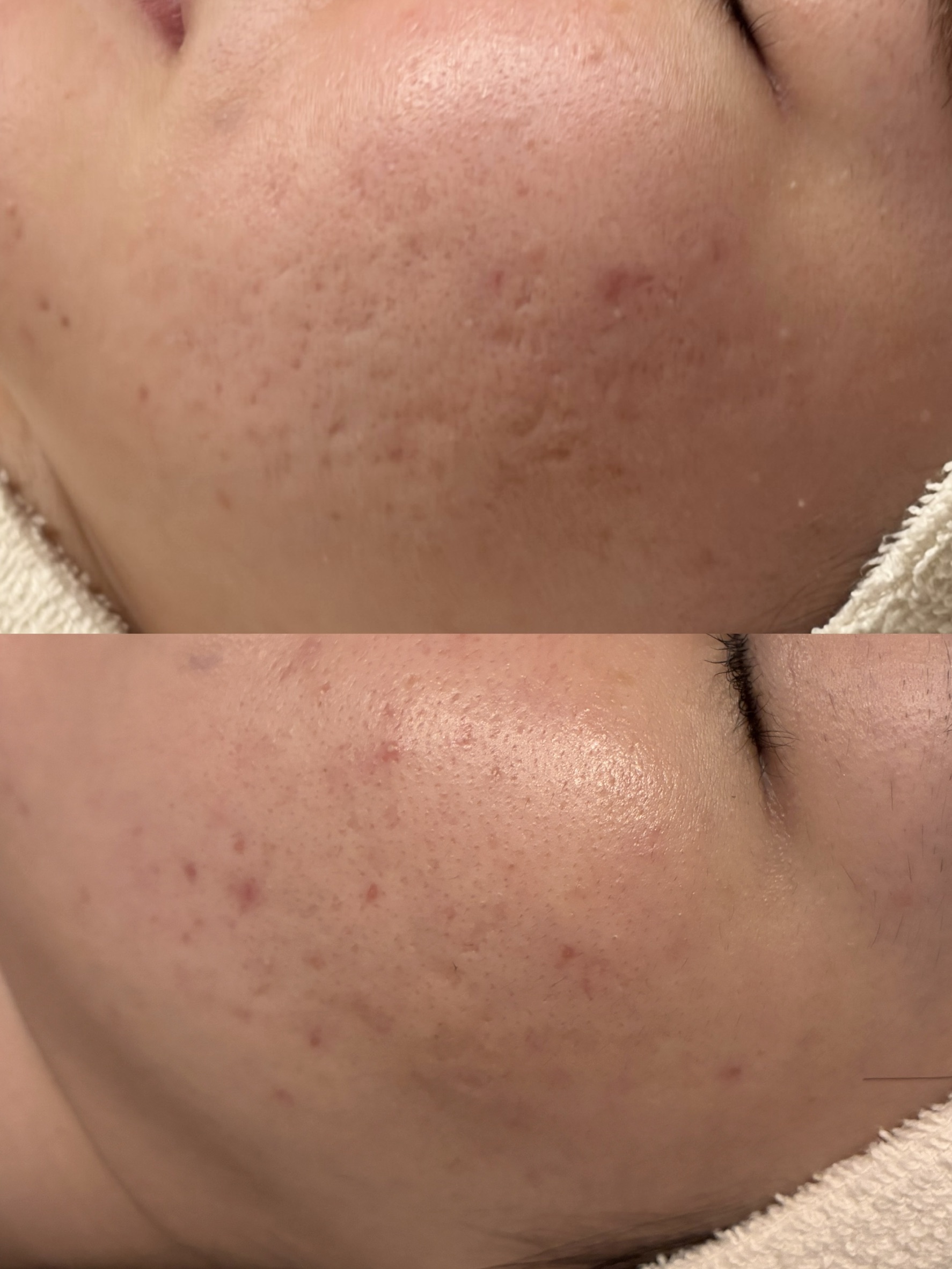 30代女性の頬のキュアジェット2回施術前後1ヶ月後の症例写真。基本薬剤はジュベルック。上がbefore、下がafter